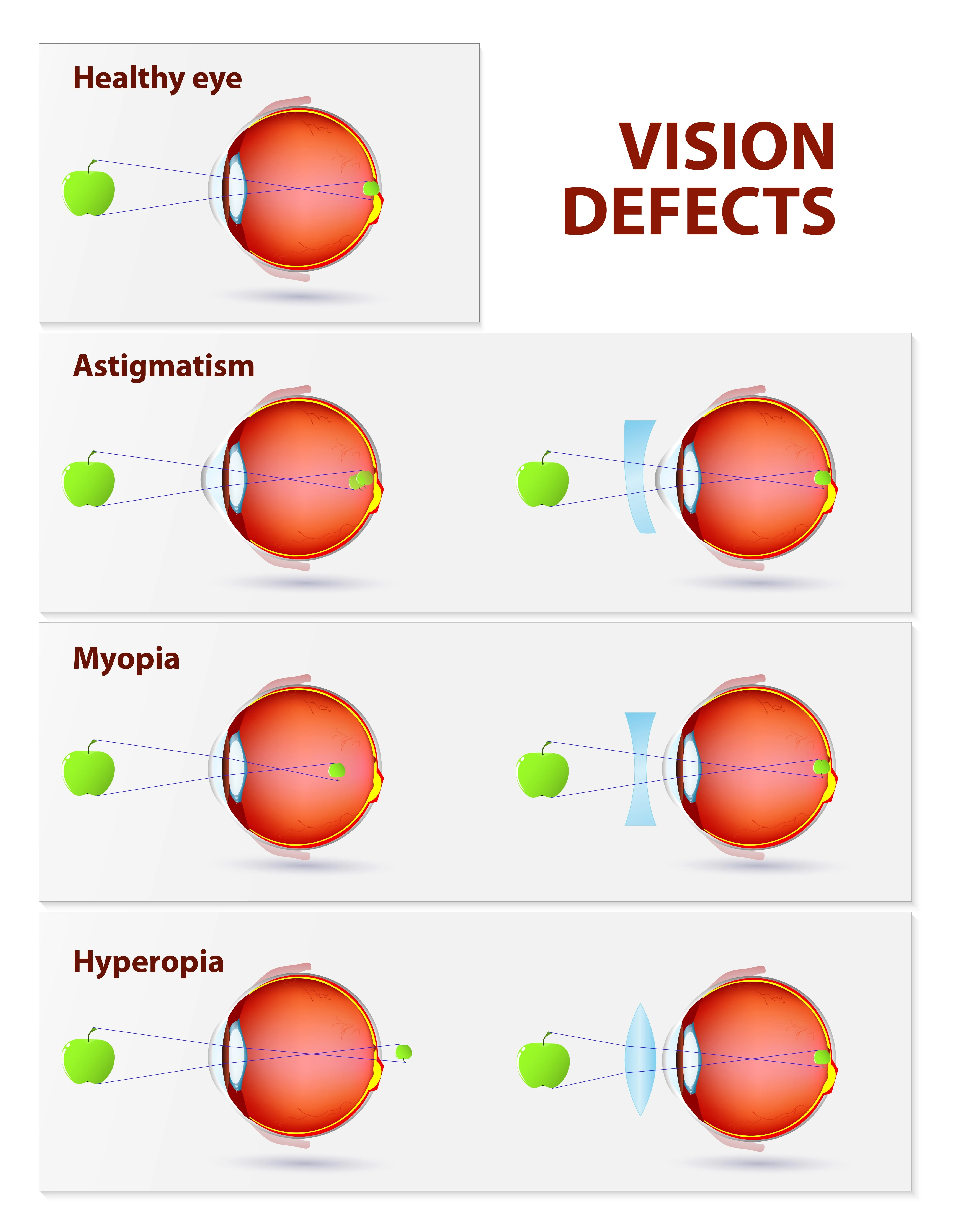 Refractive surgery corrects vision defects such as Astigmatism, Myopia and Hyperopia